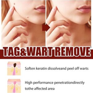tags and moles remover
